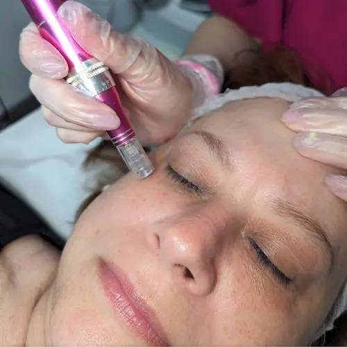 Dermapen contorno de ojos